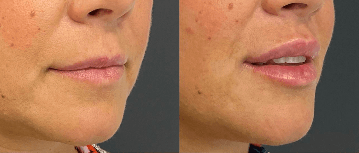 Filler Labbra — prima e dopo