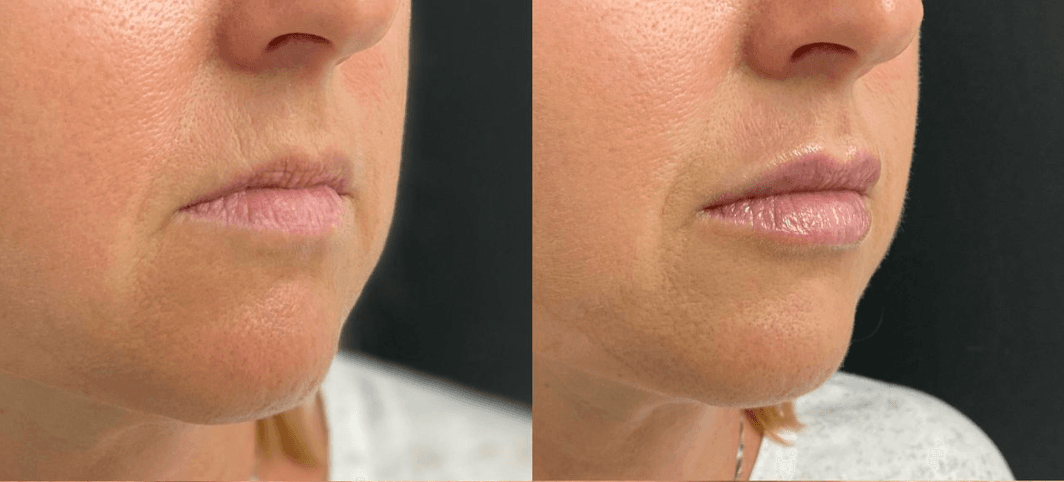 Filler Labbra — prima e dopo
